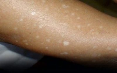 Small White Spots on Arms and Legs You Need To Know