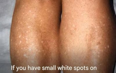 If you have small white spots on your arms or legs, it’s a clear sign that…See more