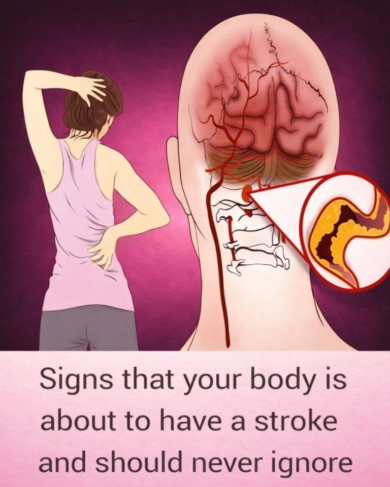 10 Early Warning Signs of a Stroke Everyone Should Know to Take Prompt Action